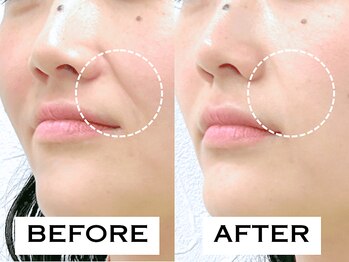 ビハリスト 新宿南口/ほうれい線が改善！