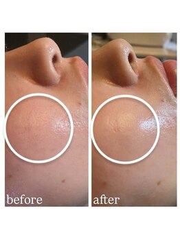 リエイト(Re:eight)/プラズマ+ハイドラ