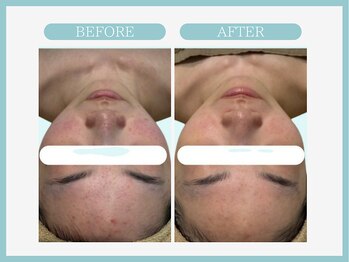 アコガレコガオ 八戸店/