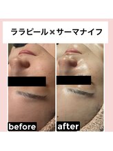 アンベリール(embellir)/透明感＆たるみケア　人気セット