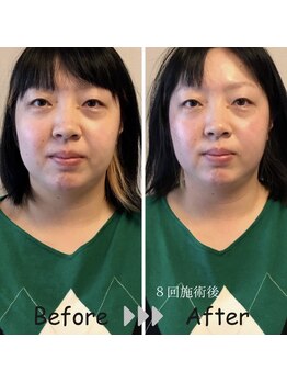 Onはり灸サロン/美容鍼のbefore→after(8回施術)