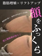 ノーブルノアール(Noble noir)/おでこ丸み復活♪