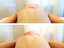 エッセンス(Essence)/お背中のビフォーアフター