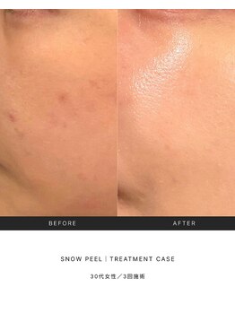 スキンラウンジ(SKIN LOUNGE)/韓国肌管理｜PDRN雪花ピール
