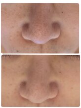 サロンド シェリー(Salon de Cherie)/毛穴エクストラクション&LDM