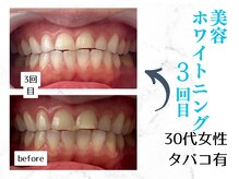 ルカノン(le canon)/愛煙家ですが歯ピカピカです！　