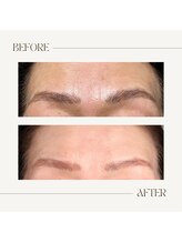 エルブラン(Herb ame)/眉間のシワ改善/脂肪分解