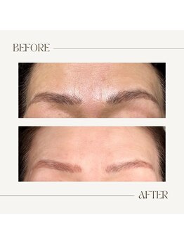 エルブラン(Herb ame)/眉間のシワ改善/脂肪分解