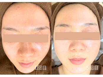 エミルカ 日の出平井店(EMILUCA)/化粧ノリもUPし明るい素肌へ