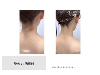 サンイチイチ(311)の写真/【挙式や成人式を控えている方に人気】うなじ+背中全体の脱毛 6.600円!最短2週間に1回施術可能◎