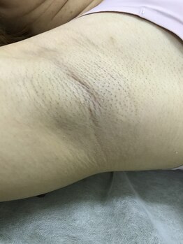 ナノハナ/鹿沼市の全身脱毛美容室ナノハナ