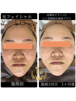 ヨロ 梅郷店(YOLO)/光フェイシャル