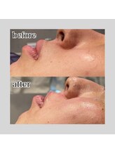 アデル 久留米(ADEL)/《全顔》口元ワックス