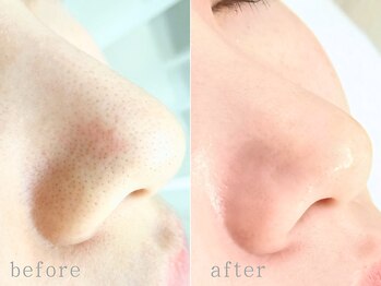 デイジー バイ アルテフィーチェ 梅田(daisy by artefice)/Face waxでで小鼻の黒ずみ◎