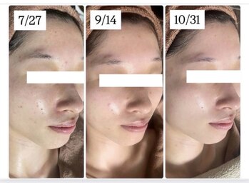 ホワイトアクア 四日市店(WHITE AQUA)/ハーブピーリング三重