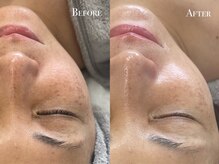 イースト(EAST)/光フェイシャル1回