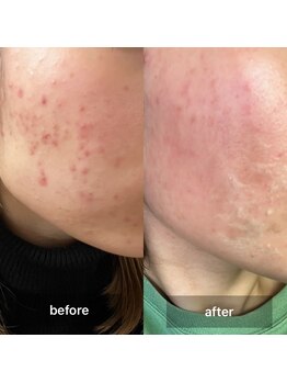 サン(SAN)/ハーブピーリング