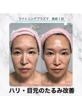 エクラ 六本木(eclat)/プラズマフェイシャル