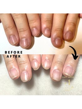 プラスワン(+1)/ハンド深爪矯正