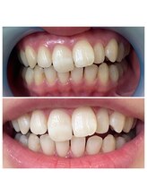 ウルト(ULT)/ホワイトニングBeforeAfter