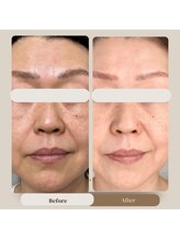 エルブラン(Herb ame)/シミ・シワ・たるみ改善