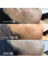 トータルエステティック ビューティスト 足利店(Total Easthetic Beautist)/エルモサブラックハーブ