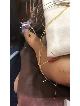 仁接骨院 じん鍼灸治療院/鍼通電