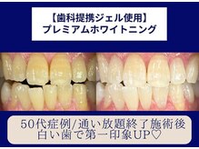 ホワイトニングカフェ 立川店(WhiteningCafe)/◎歯のホワイトニング施術写真