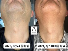 フィズ 多摩センター店(FIS)/☆脱毛途中経過［多摩センター］