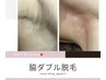 1度でつるつる！ちくちくしない♪両脇ダブル脱毛（wax＋光）5000円　