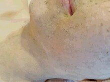 ペティアン レーヴ(PETILLANT reve)/【毛穴・美肌】ハーブピーリング