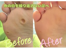 ニコルル 大阪天満店(Nicolulu)/大きな魚の目ビフォーアフター