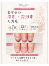 ティアラネイル 宇都宮&nbsp;栃木県初！ 深爪矯正