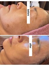 ソワイユ 浜松店(Soyeux)/肌質改善（VOS）　before→after