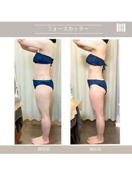 カリスボーテ 関本店/フォースカッター