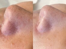 リジュベ(Rejuve)/毛穴/コラーゲンマシン/船橋毛穴