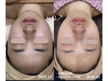 エステティック レイビス 八戸店(RAYVIS)/RAYVIS自慢の顔脱毛♪