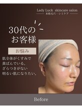 レディラック 大阪梅田本店(Lady Luck)/シミ毛穴集中ケアコース