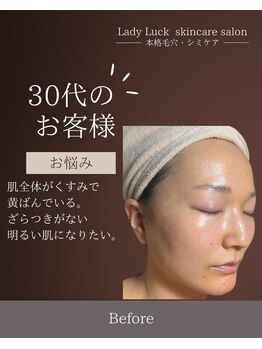 レディラック 大阪梅田本店(Lady Luck)/シミ毛穴集中ケアコース
