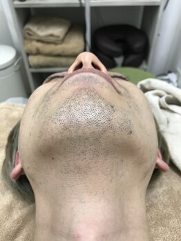 ナノハナ/鹿沼市の全身脱毛美容室ナノハナ