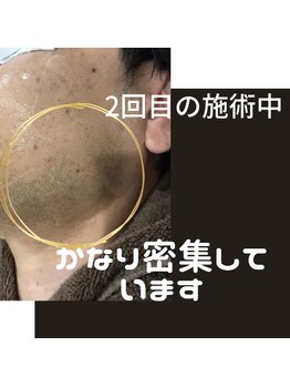 エル(AILE)/before~(2回目脱毛時点)