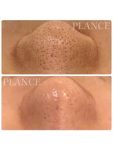 プランス 恵比寿店(PLANCE)/恵比寿/エステ/毛穴洗浄