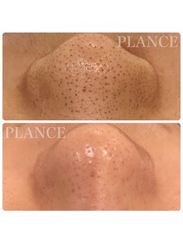 プランス 恵比寿店(PLANCE)/恵比寿/エステ/毛穴洗浄