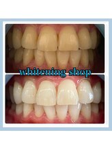 ホワイトニングショップ 堺東店/【ビフォーアフター】10回