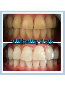 ホワイトニングショップ 堺東店/【ビフォーアフター】10回