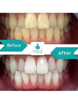 ティンクルホワイト 成田店/ビフォーアフター２