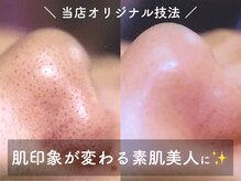 セルフィー/人気の毛穴洗浄&吸引エステ