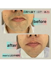 ランドマーク 中崎町(LANDMARK.)/《 鼻下・口下・あご 》