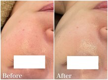 サロンドフェイス(Salon de Faith)/【ハーブピーリング】2回施術♪