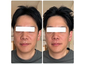 ボーンズ(BONES)/男性にも効果あり小顔矯正